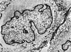 F, 49y. | myelosarcoma … histiocyte-like cells in dermal infiltrates